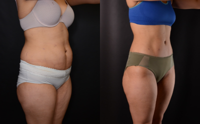 Tummy Tuck before and after photo
