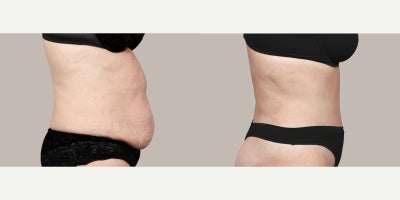 Tummy Tuck before and after photo