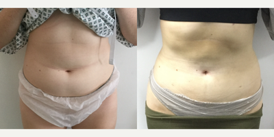 Vaser Liposuction before and after photo