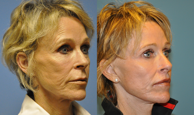 Facial Fat Transfer before and after photo