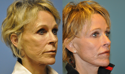 Facial Fat Transfer before and after photo