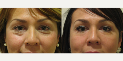 Dermal Fillers before and after photo
