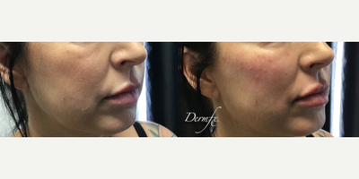 Cheek Augmentation before and after photo
