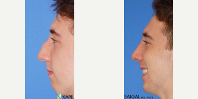 Chin Implant before and after photo