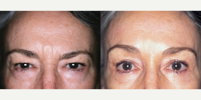 Eyelid Surgery before and after photo