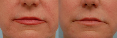 Facial Fat Transfer before and after photo