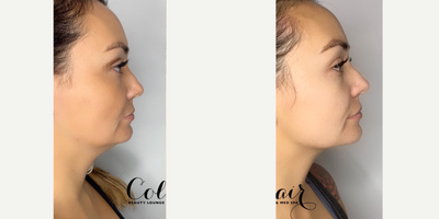 Kybella before and after photo