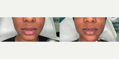 Chin Filler before and after photo
