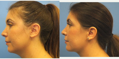 Chin Liposuction before and after photo