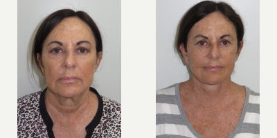 Facelift before and after photo