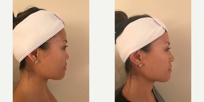Nonsurgical Nose Job before and after photo