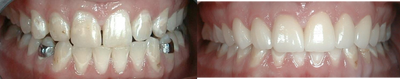 Porcelain Veneers before and after photo