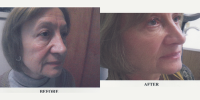 Radiesse before and after photo