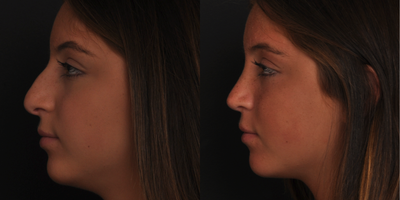 Rhinoplasty before and after photo
