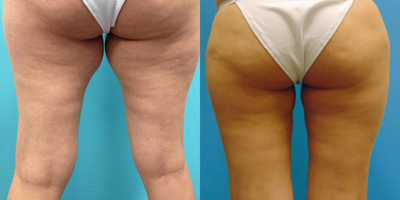 SlimLipo before and after photo