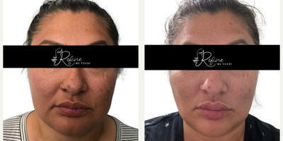 Thread Lift before and after photo