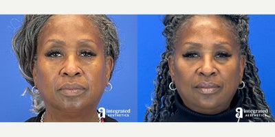Voluma before and after photo