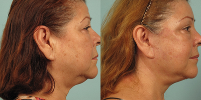 Facelift before and after photo