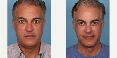 Facelift before and after photo