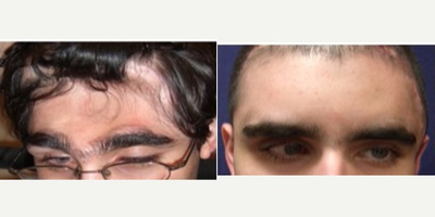 Facial Reconstructive Surgery before and after photo