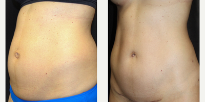 Tummy Tuck before and after photo