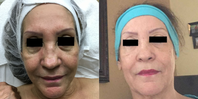 Vampire Facelift before and after photo