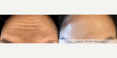 Botox before and after photo