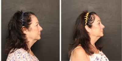 Eyelid Surgery before and after photo
