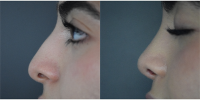Rhinoplasty before and after photo