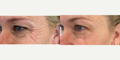 Botox before and after photo