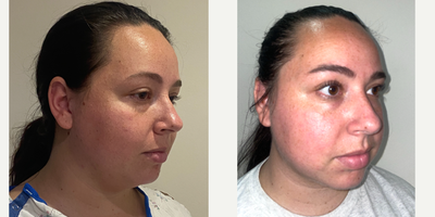 Chin Liposuction before and after photo