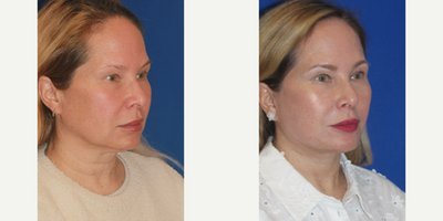 Deep Plane Facelift before and after photo