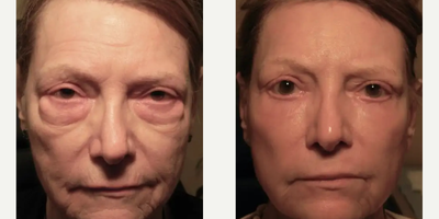 Eyelid Surgery before and after photo