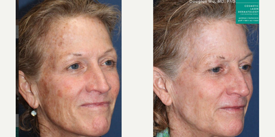IPL before and after photo
