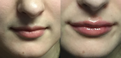 Lip Fillers before and after photo