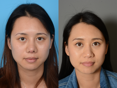 Asian Rhinoplasty before and after photo