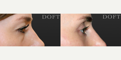 Eyelid Surgery before and after photo