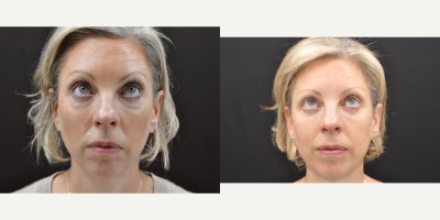 Eyelid Surgery before and after photo