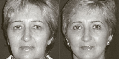 Facelift before and after photo