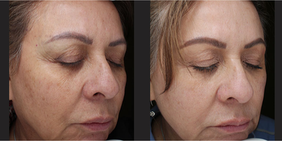 Halo Laser before and after photo
