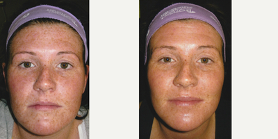 IPL before and after photo