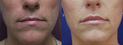 Juvederm before and after photo