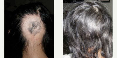 PRP for Hair Loss before and after photo