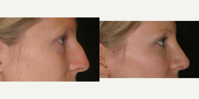 Rhinoplasty before and after photo