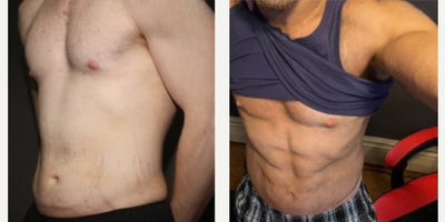 Abdominal Etching before and after photo