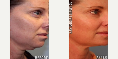 Dermal Fillers before and after photo