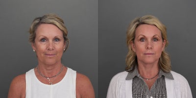 Facelift before and after photo