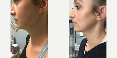 Kybella before and after photo