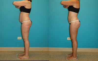 Smart Lipo before and after photo