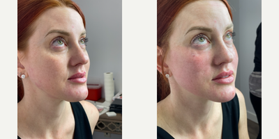 Belotero before and after photo